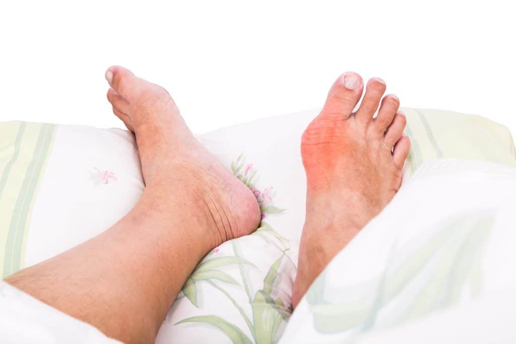 artroza stopala liječenje oblozima