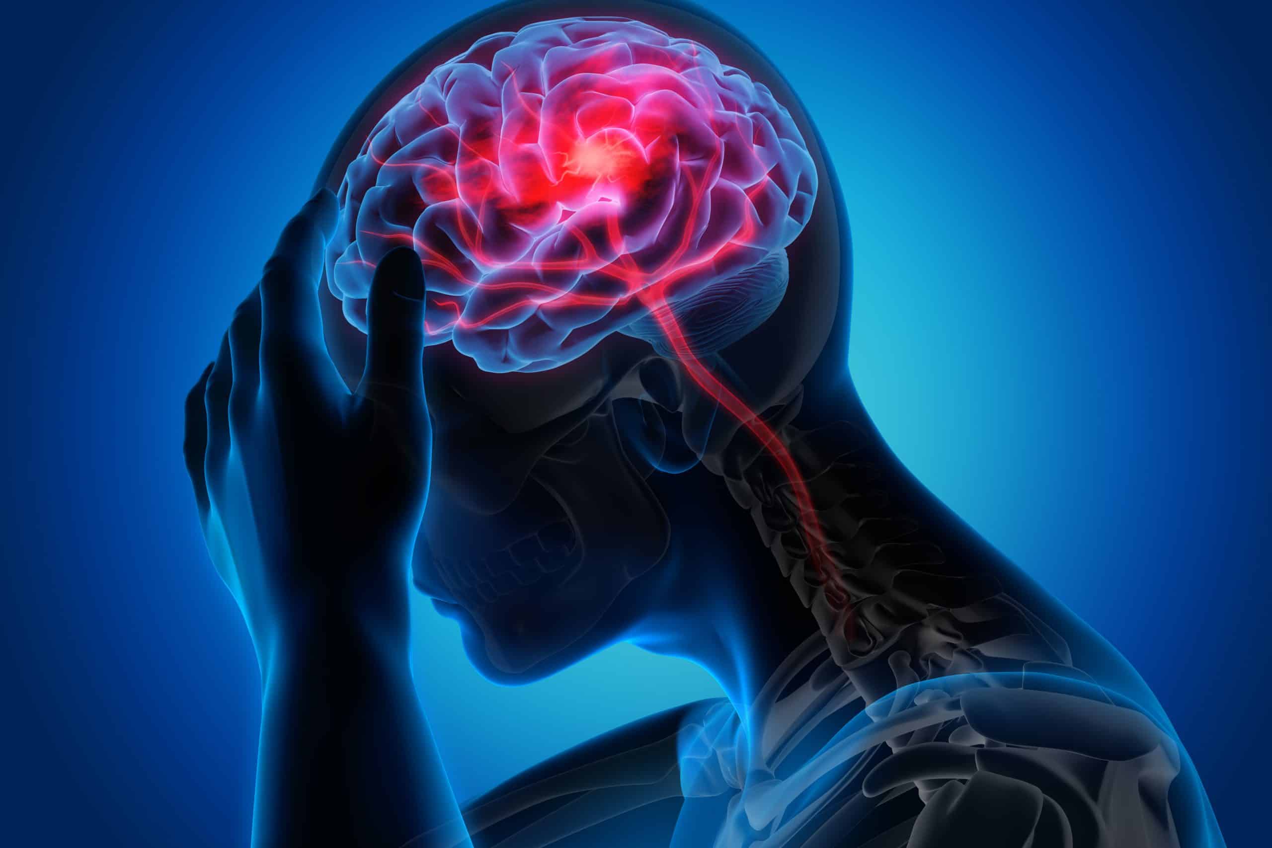 Simptomi moždanog udara