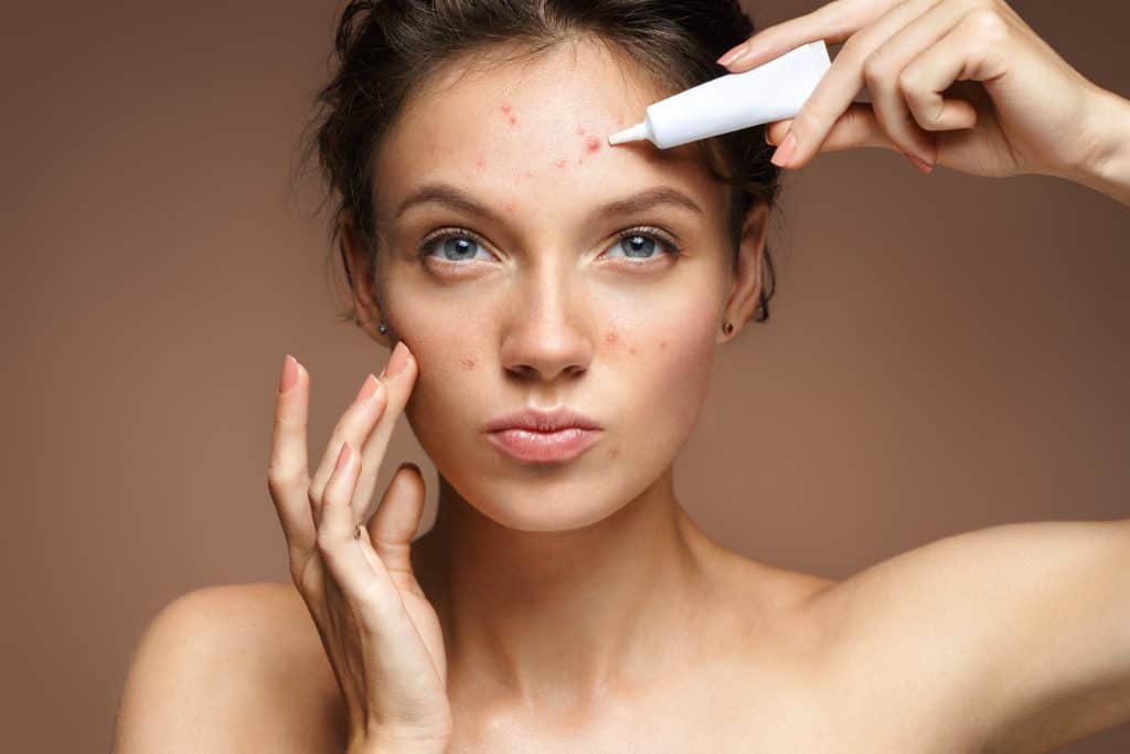 Akne na licu - zašto nastaju i kako ih liječiti