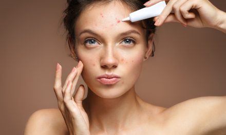 Akne na licu – zašto nastaju i kako ih liječiti