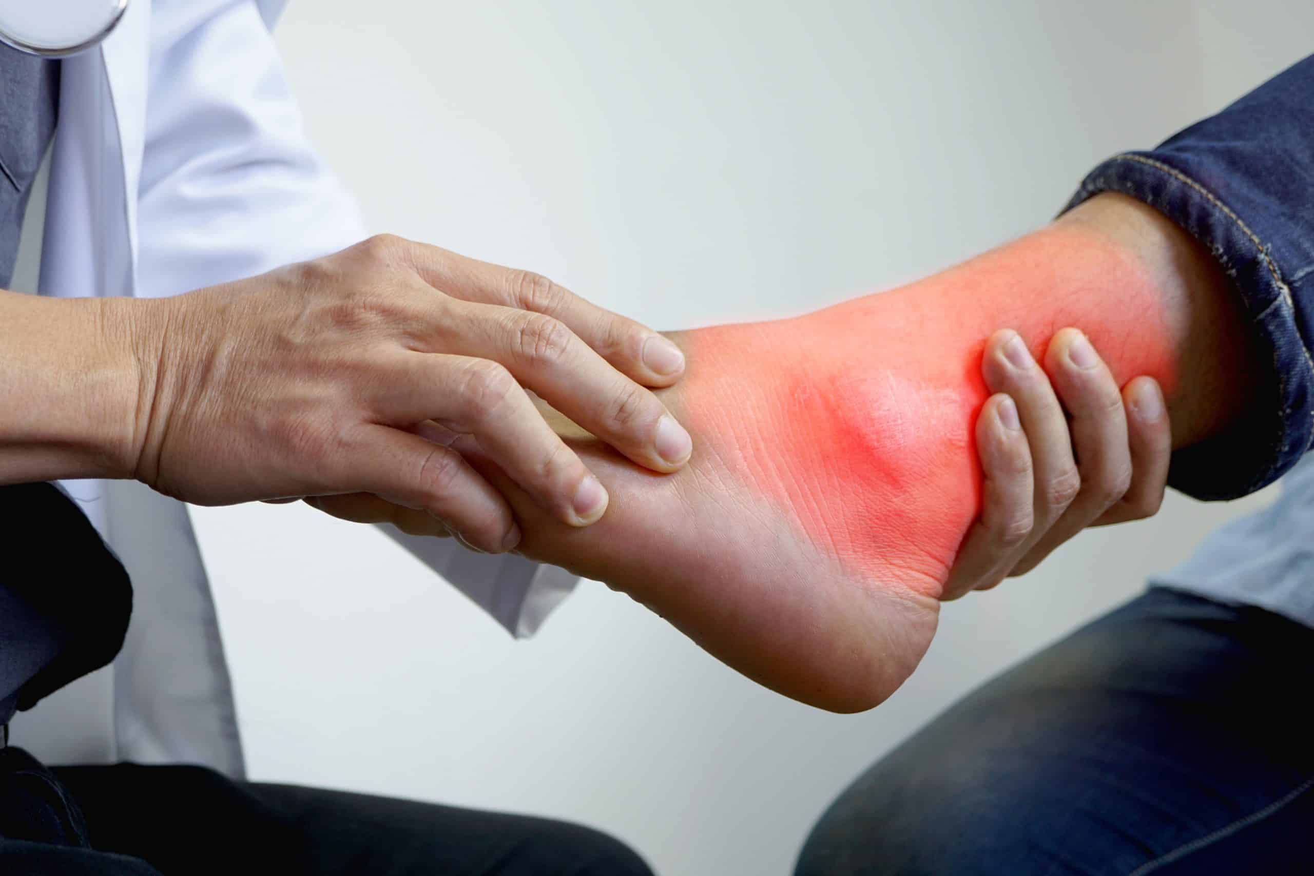simptomi i liječenje gihta stopala