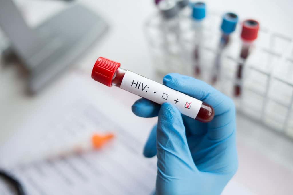 HIV test - kada je potrebno otići na testiranje