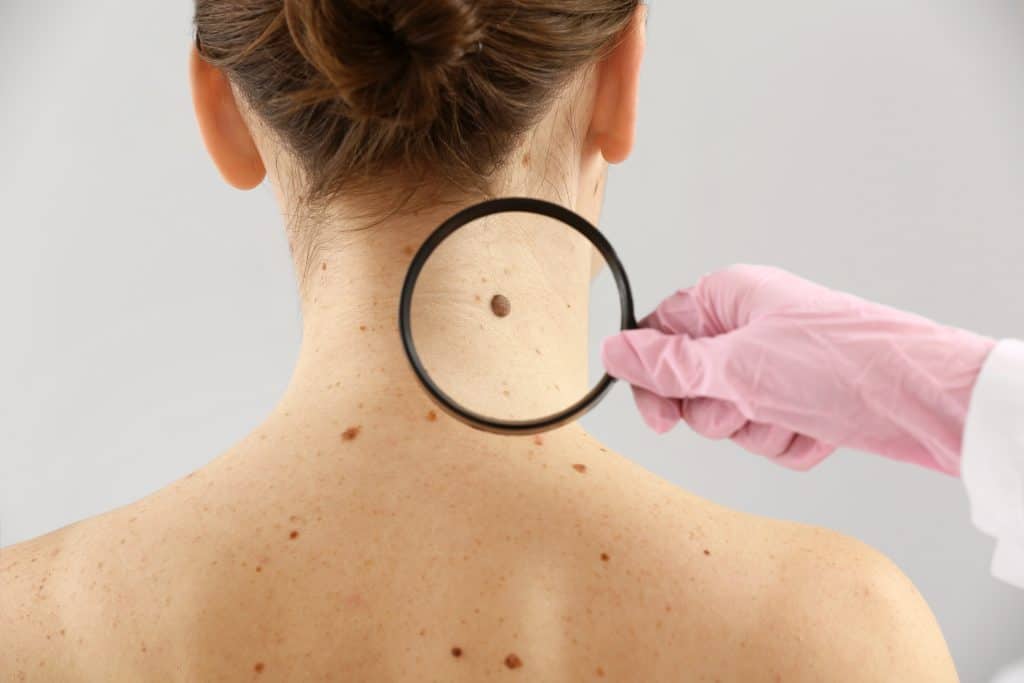 Rak kože - simptomi koji ukazuju na ovu opaku bolest