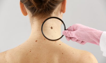 Rak kože – simptomi koji ukazuju na ovu opaku bolest