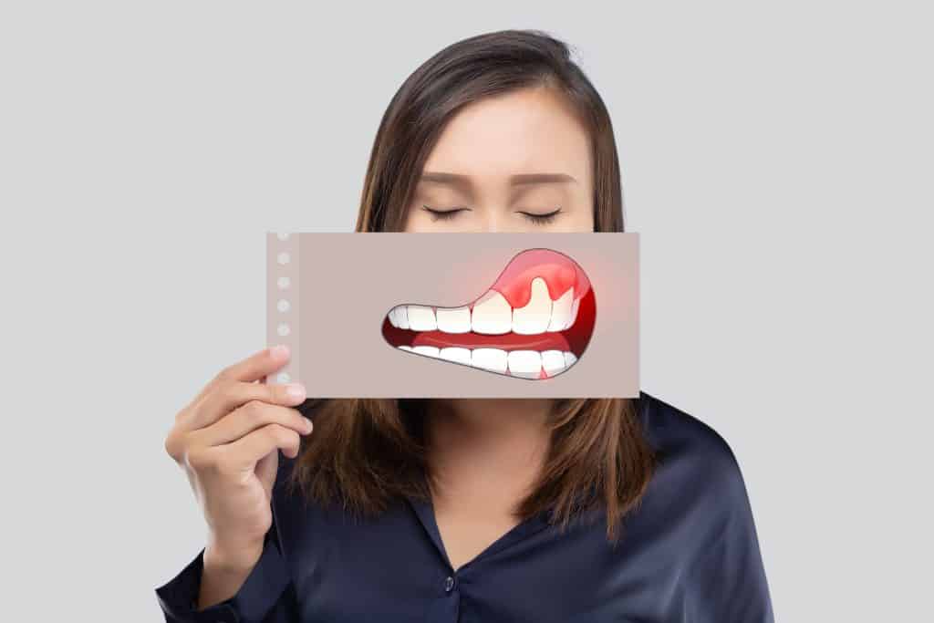 Upala zubnog mesa - simptomi i liječenje