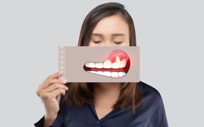 Upala zubnog mesa – simptomi i liječenje