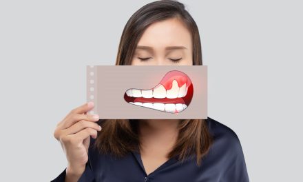 Upala zubnog mesa – simptomi i liječenje
