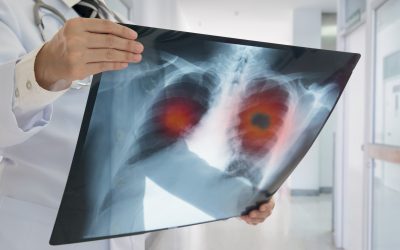 Emfizem pluća – simptomi, uzroci i liječenje