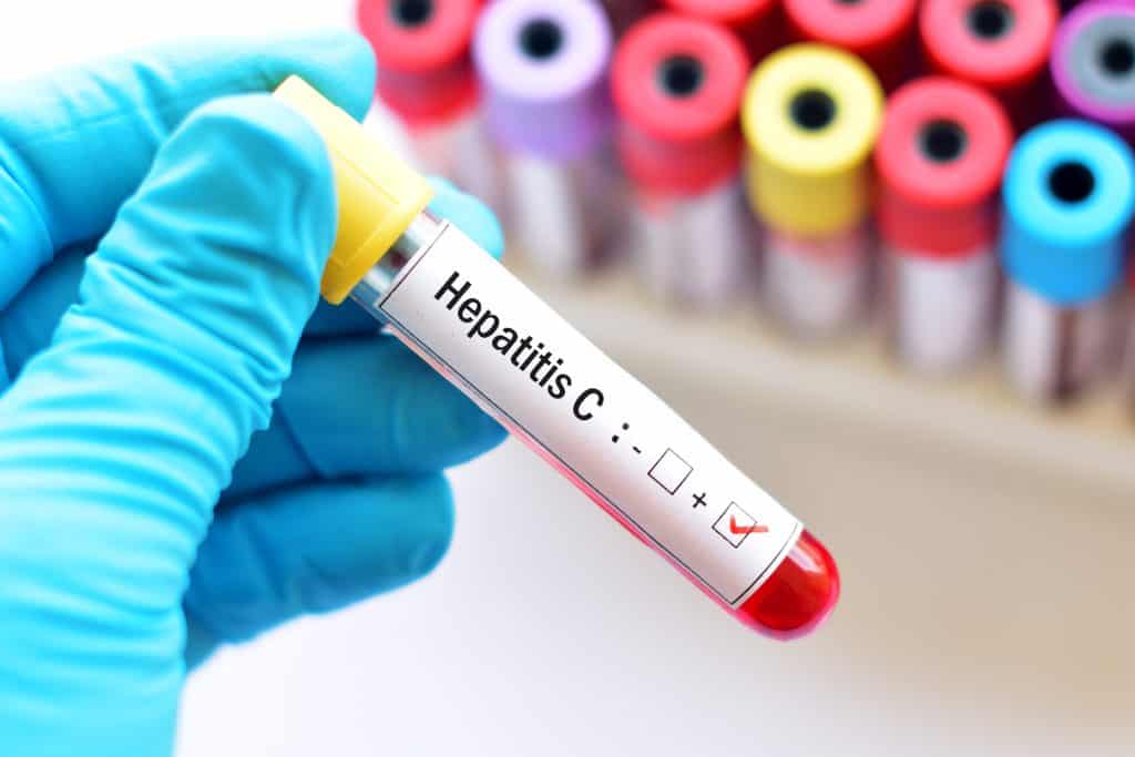 Hepatitis C - uzrok, simptomi i liječenje