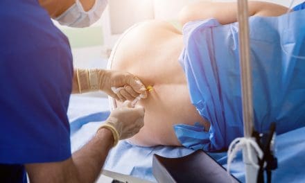 Što je epiduralna anestezija