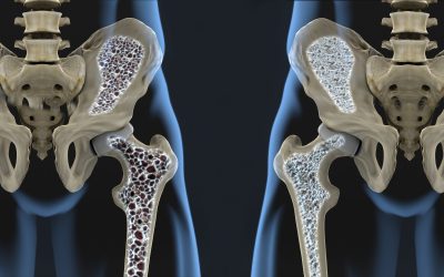 Što je osteoporoza, koji su simptomi i kako se liječi
