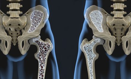 Što je osteoporoza, koji su simptomi i kako se liječi
