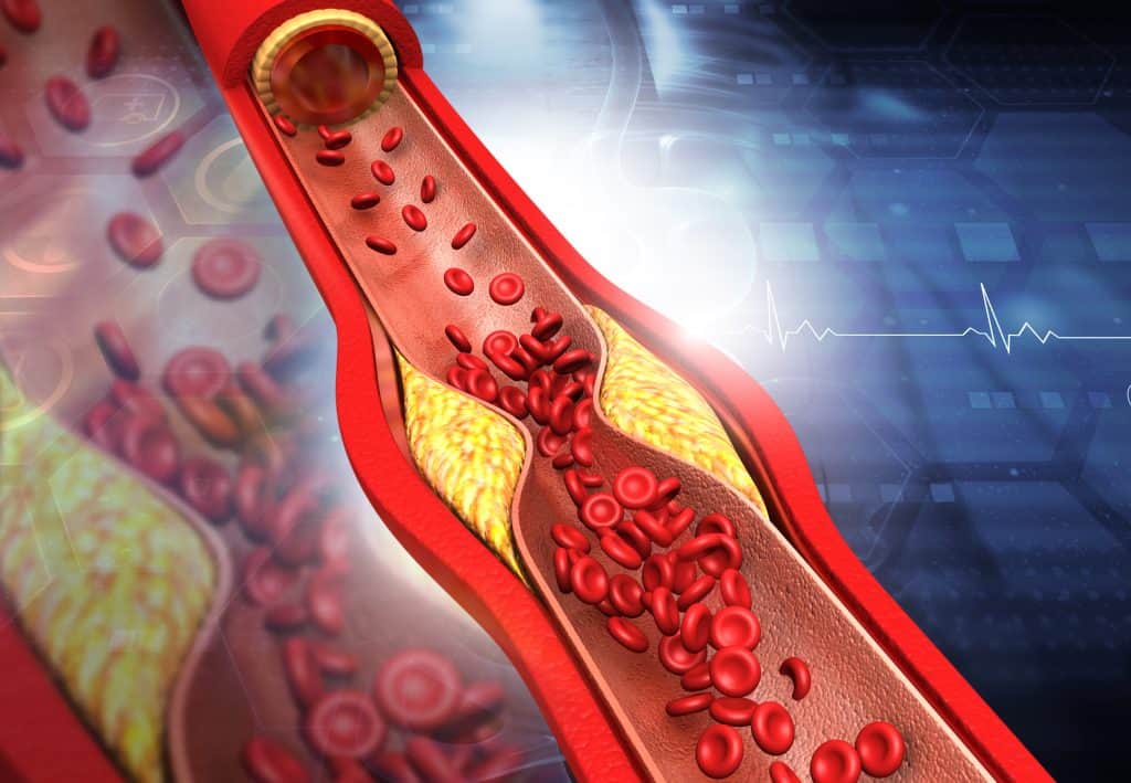 Što je povišen kolesterol - prehrana i liječenje