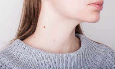 Bradavice na vratu – kako ih ukloniti