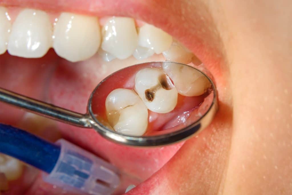 Karijes na zubu - uzrok, simptomi i liječenje