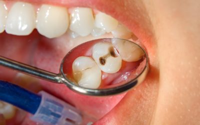 Karijes na zubu – uzrok, simptomi i liječenje