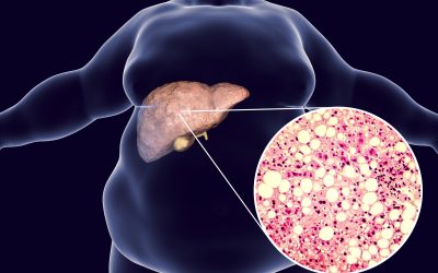 Masna jetra – uzrok, simptomi, prehrana