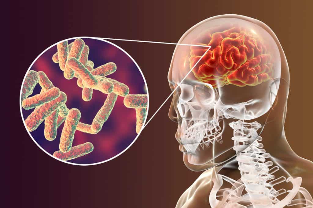 Meningitis - uzrok, simptomi, posljedice, liječenje