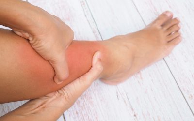 Oticanje nogu – simptomi, uzrok i liječenje