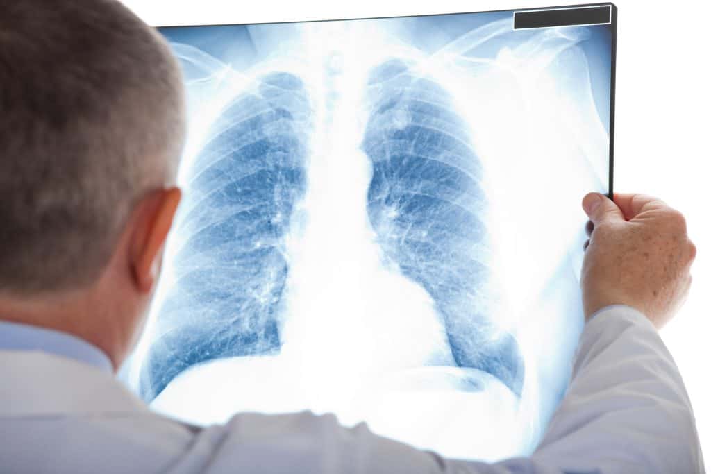 Plućna embolija - uzrok, simptomi i liječenje