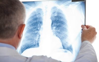 Plućna embolija – uzrok, simptomi i liječenje