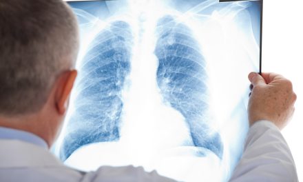 Plućna embolija – uzrok, simptomi i liječenje