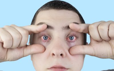 Pucanje kapilara u oku – uzrok, simptomi i liječenje