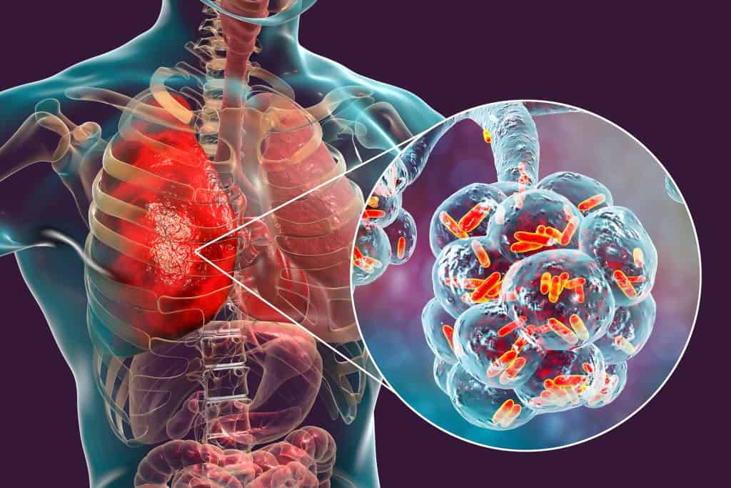 Što je upala pluća - uzrok, simptomi i liječenje