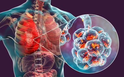 Što je upala pluća – uzrok, simptomi i liječenje