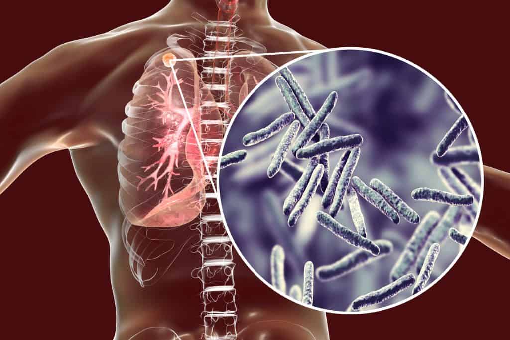 Tuberkuloza (TBC) pluća - simptomi, liječenje i cjepivo