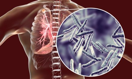 Tuberkuloza (TBC) pluća – simptomi, liječenje i cjepivo