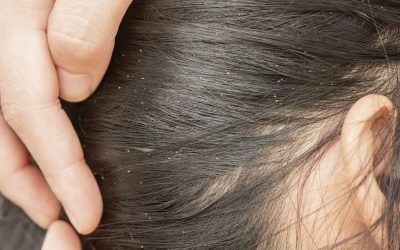 Uši u kosi – kako izgledaju i kako ih se riješiti