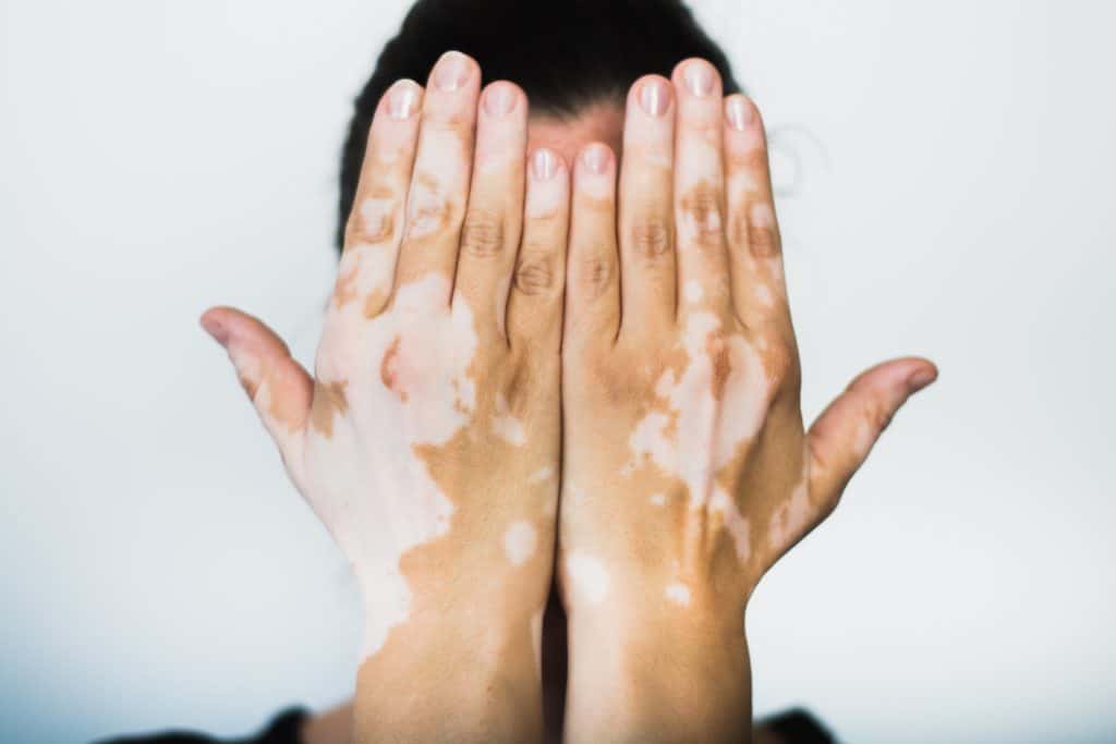 Vitiligo bolest - depigmentacija kože