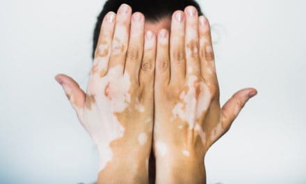 Vitiligo bolest – depigmentacija kože