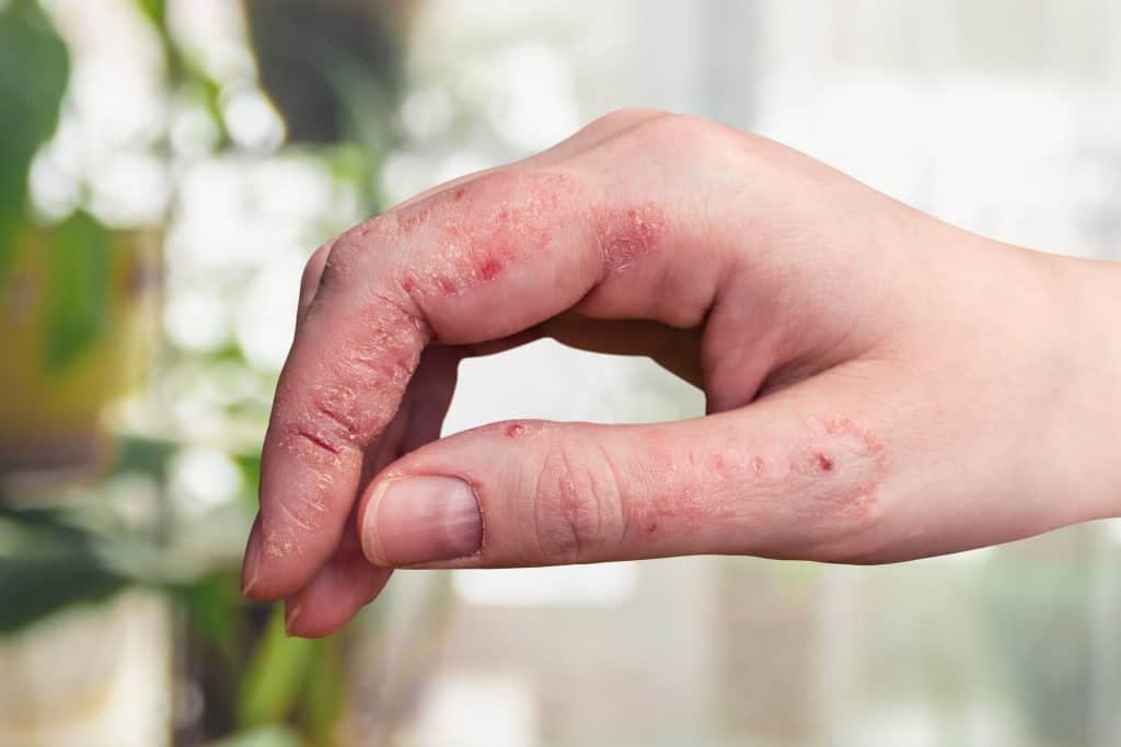 Gljivice na rukama - uzrok i liječenje