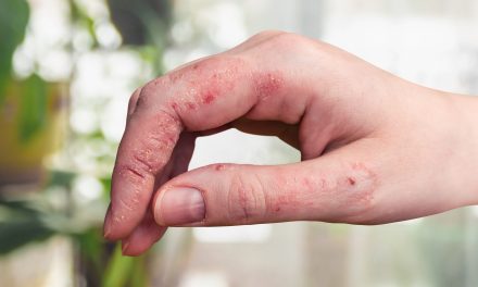 Gljivice na rukama – uzrok i liječenje