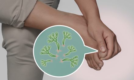 Gljivična infekcija kože i noktiju – uzrok i liječenje
