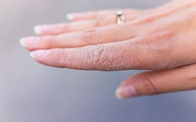 Ispucale ruke – uzrok suhoće i liječenje