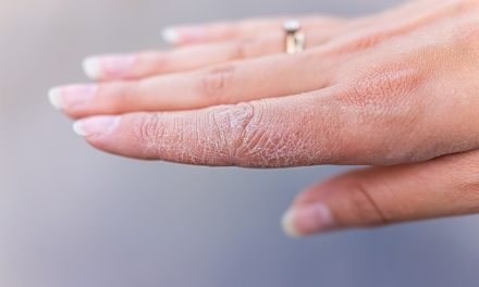 Ispucale ruke – uzrok suhoće i liječenje