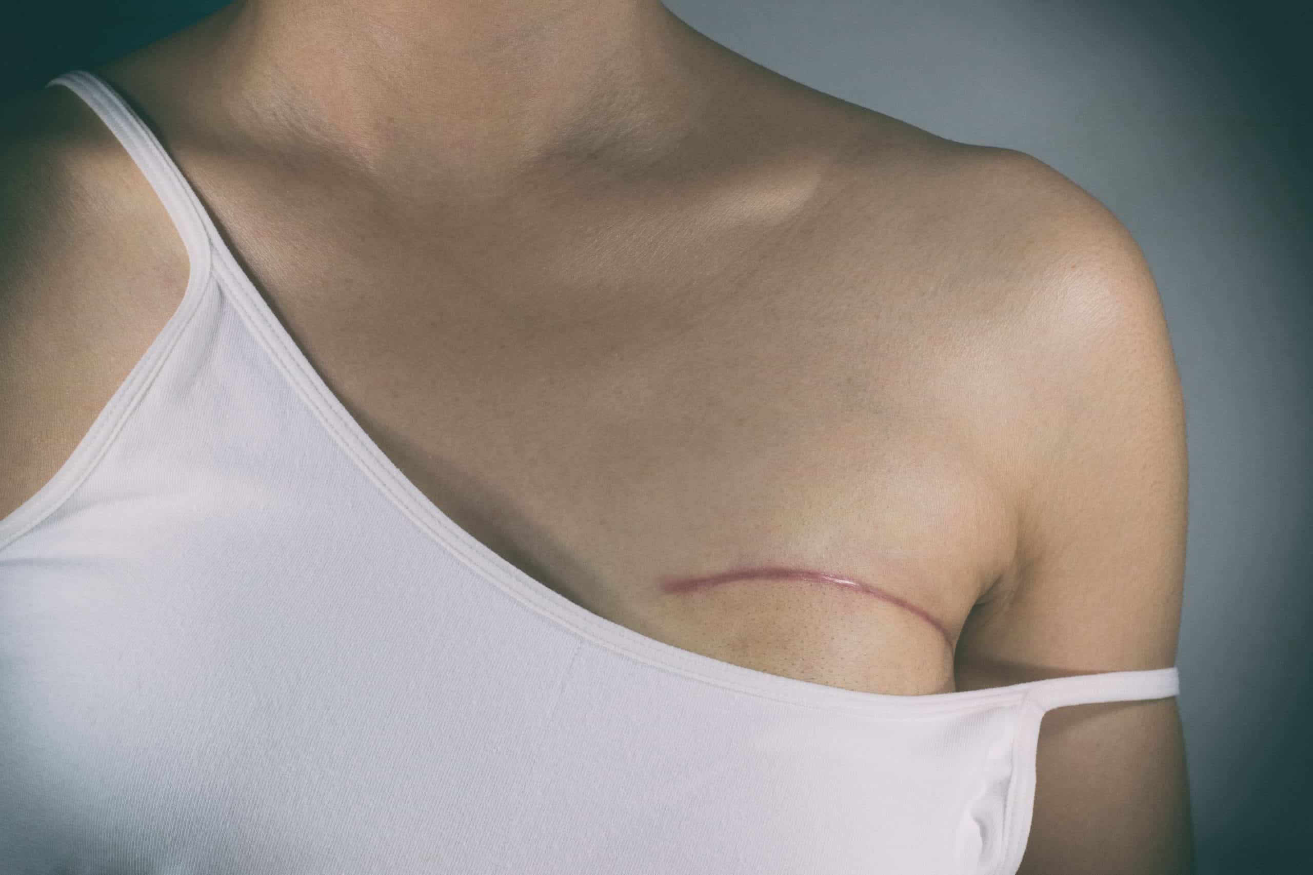 bol u ramenima nakon mastektomije kako ublažiti bol upalom ramenog zgloba