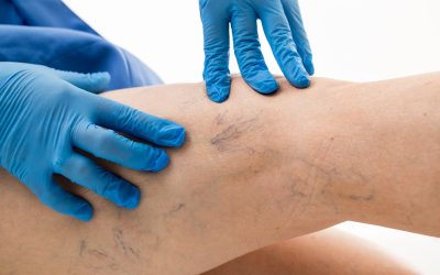 Proširene vene na nogama – uzrok, simptomi i liječenje