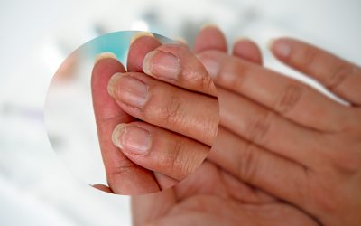 Pucanje noktiju na rukama i nogama – uzrok i liječenje