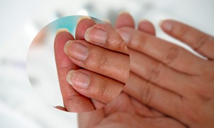 Pucanje noktiju na rukama i nogama – uzrok i liječenje