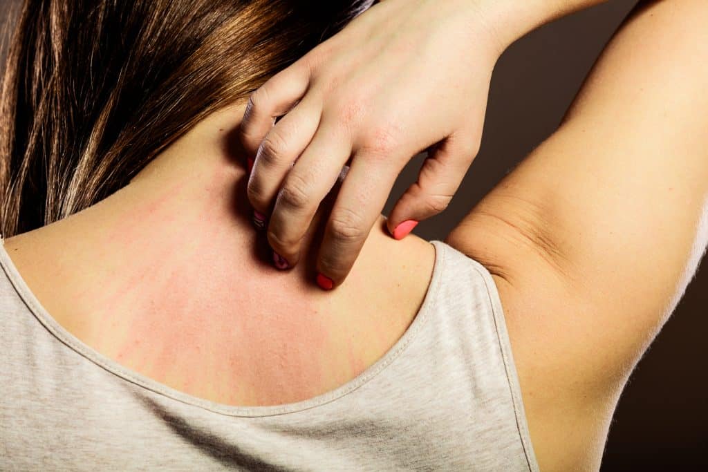 Svrab kože - uzrok, simptomi i liječenje