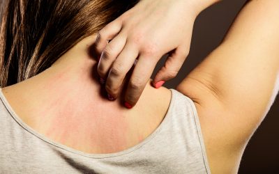 Svrab kože – uzrok, simptomi i liječenje