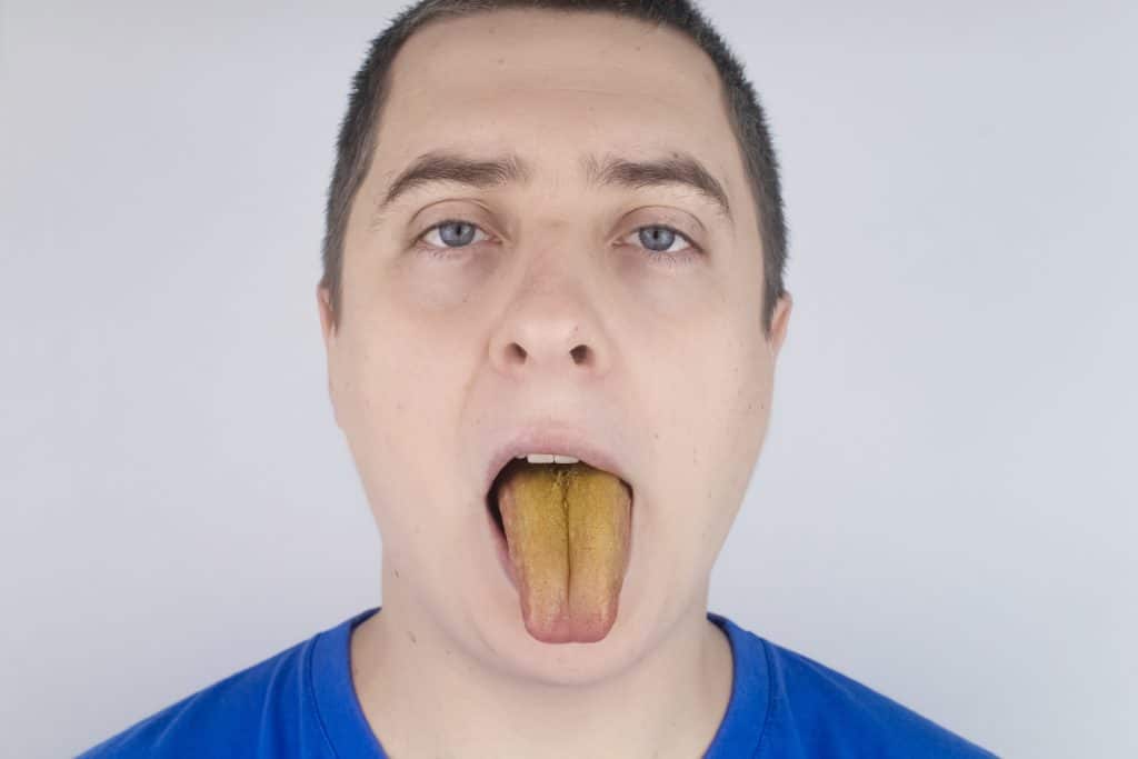 Žuti jezik - uzrok i liječenje