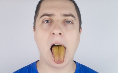 Žuti jezik – uzrok i liječenje