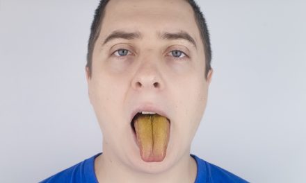 Žuti jezik – uzrok i liječenje
