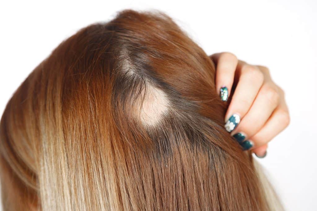 Alopecija (ispadanje kose) - uzrok i liječenje