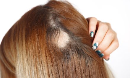 Alopecija (ispadanje kose) – uzrok i liječenje